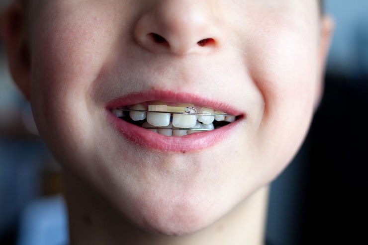 bambino denti patologia